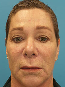 Facelift before